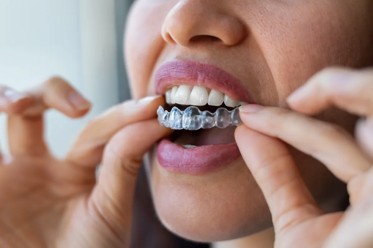 Close-up of a clear Invisalign aligner being placed by hand
